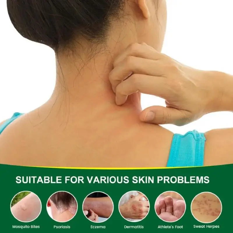 30g 2 cans Premium All-Natural Herbal Soothing Cream for Psoriasis, Eczema, Dry & Sensitive Skin Relief | Plant-Based Itch Treatment Balm for Mosquito Bites -