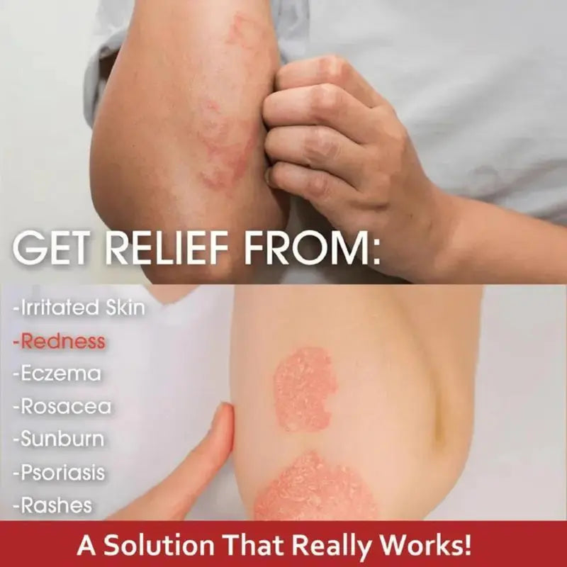 30g 2 cans Premium All-Natural Herbal Soothing Cream for Psoriasis, Eczema, Dry & Sensitive Skin Relief | Plant-Based Itch Treatment Balm for Mosquito Bites -