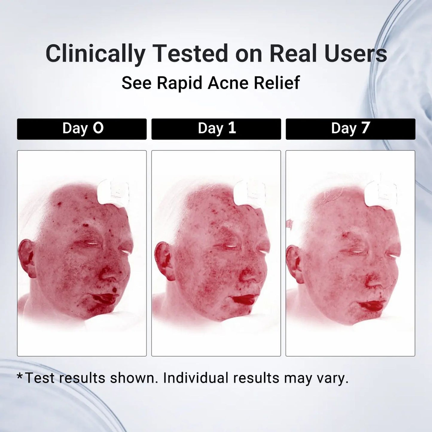 Dr.Leo Drying Lotion | Pimple Treatment & Body Acne Treatment | Visibly Shrinks Pimples in 24 Hours & Helps Fade Acne Marks in 7 Days | With 1.8% Encapsulated Salicylic Acid, 4% Niacinamide & 10% Sulfur (20ml) #DealsForYouDays,beachoutfits image 5