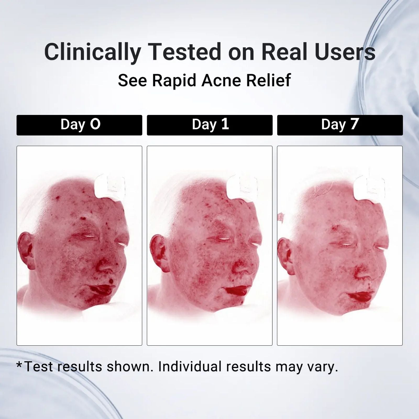 Dr.Leo Drying Lotion | Pimple Treatment & Body Acne Treatment | Visibly Shrinks Pimples in 24 Hours & Helps Fade Acne Marks in 7 Days | With 1.8% Encapsulated Salicylic Acid, 4% Niacinamide & 10% Sulfur (20ml) #DealsForYouDays,beachoutfits image 5